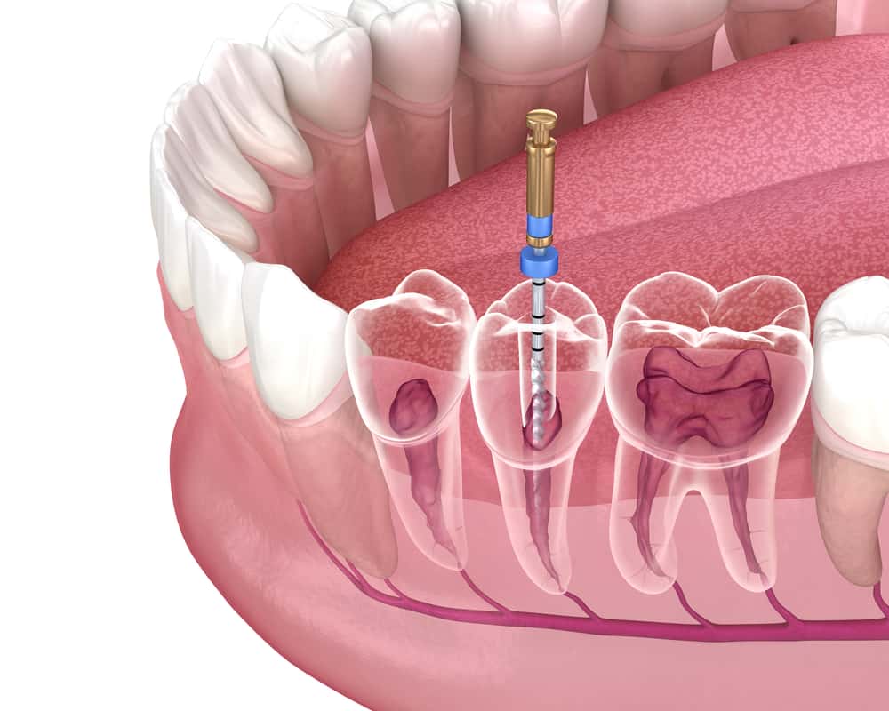 Root Canal Treatment: A Comprehensive Guide for Australian Dental Patients